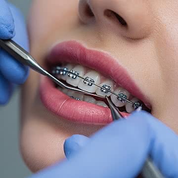 pngtree dentist filling teeth of patient with orthodontic braces in close up image 17441006