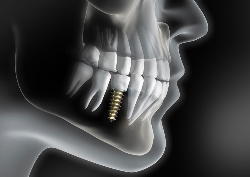 single tooth dental implants 1